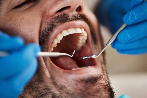 Best Emergency Wisdom Teeth Removal in Canyonville, OR